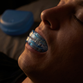 RESTIX Mouthguard Being Worn